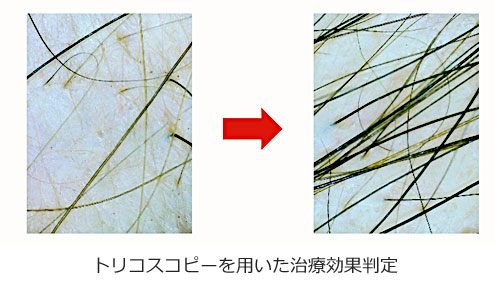 トリコスコピーを用いた治療効果判定